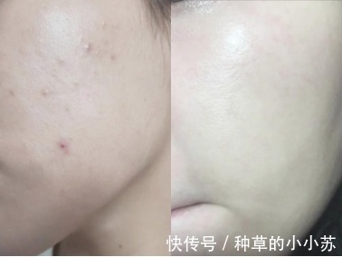 爆痘|油皮护肤攻略!夏季爆痘、黑头、毛孔粗大?我来拯救你们了!