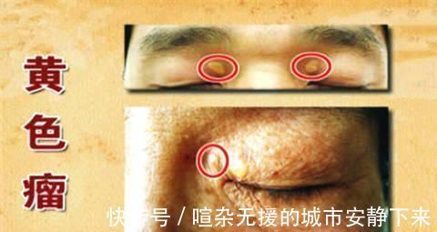 黄色瘤|降血脂的“冠军”找到了,搭配水一起喝,血管干净、血脂降下来了