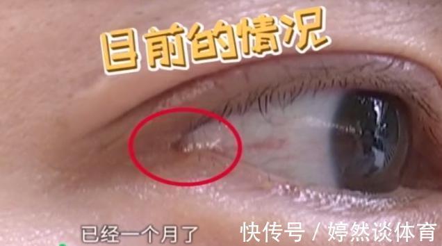 开眼角 姑娘做“开眼角”，术后却感觉眼睛不对劲？医生：确实少缝了一针