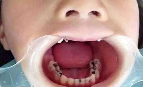 宝宝|3岁宝宝满口“小黑牙”,罪魁祸首不是糖果,而是家长的无知