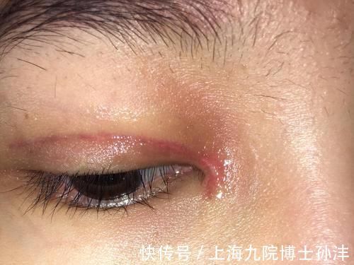 祛疤 全切双眼皮术后需要使用消除伤疤的药吗,多久可以使用?