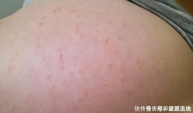 肚皮|在怀孕后,女性皮肤上的变化较为明显,这五点看看你有没有中招