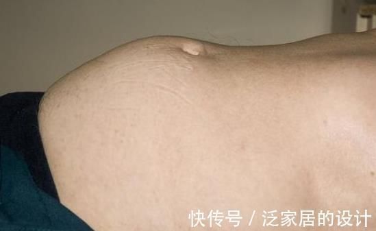 症状|提醒:5个身体症状,说明肝病在“恶化”,为健康别轻视