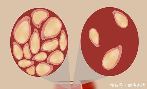 甘油三酯升高，腿部不会“忽悠”人，若出现3种迹象，需趁早降脂