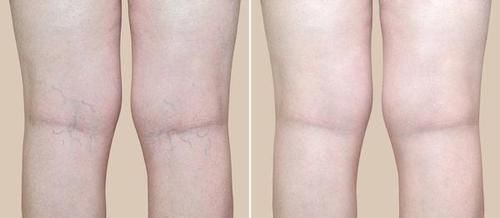 症状|体内有血栓,腿先知!腿部出现这些特征,警惕血管越来越窄