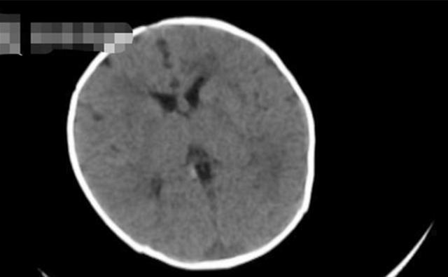 新生儿也会突发脑出血?或因这个“陋习”所致,宝妈们赶紧自查