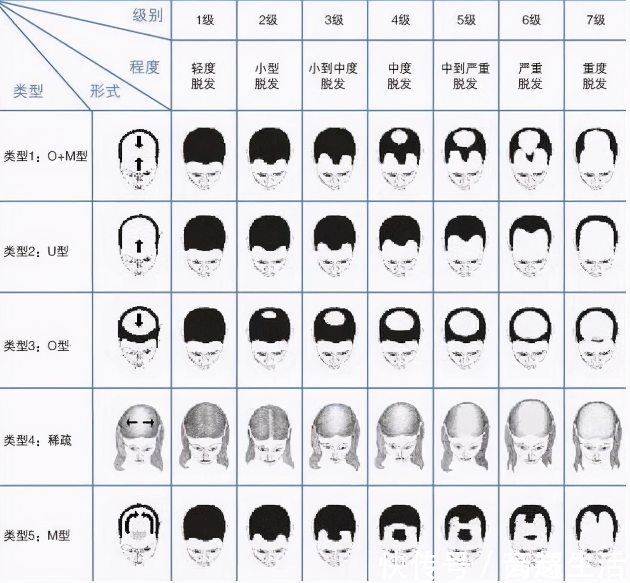 衰老期|男人开始衰老,有6个表现!占3个以上,可能已提早步入衰老期