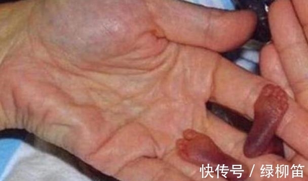 早产儿|''拇指姑娘''出生时仅25厘米,被诊断活不到1岁,结果却出人意料