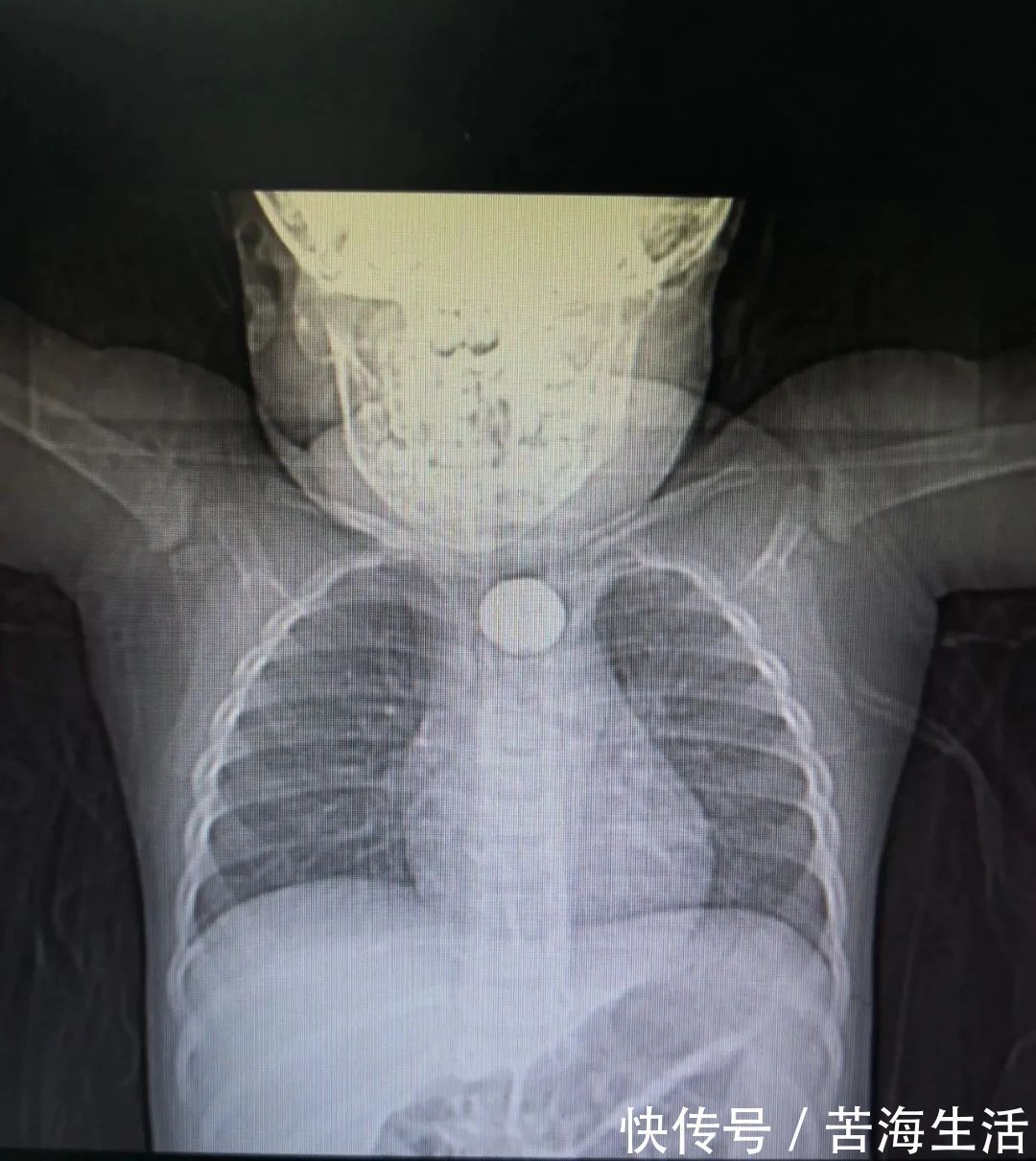 小金|食管被烧黑!2岁娃来深紧急手术,只因吃下这东西!家里太常见