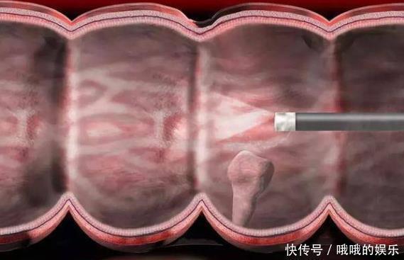 检查|上厕所时若出现3个迹象,或许是肠道有息肉了,请尽早去检查下