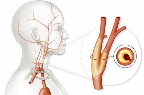 颈动脉内膜|“血管老化”的五大常见征象，您有吗？及时干预，哪些药物可选？