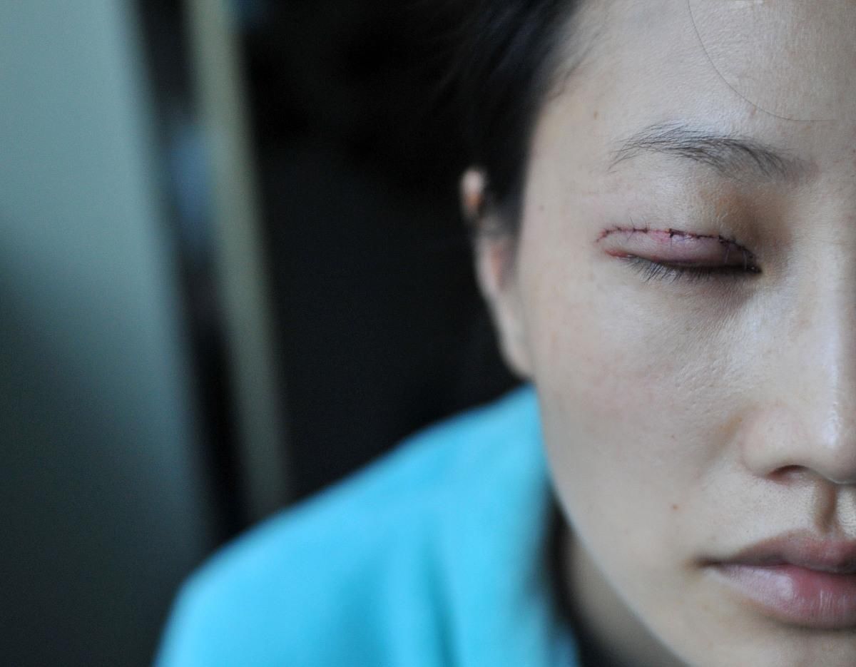 美瞳线常见操作答疑,有这些情况不能操作美瞳线