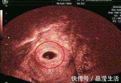 检查|怀孕两个月,检查没有胎心胎芽,检查只有个空壤这是什么情况啊?