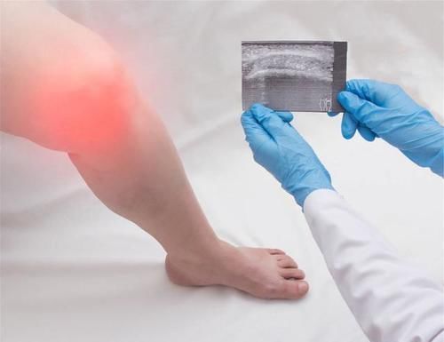 骨科主任:1种零食敞开吃,补骨更养骨,滑膜炎或好转