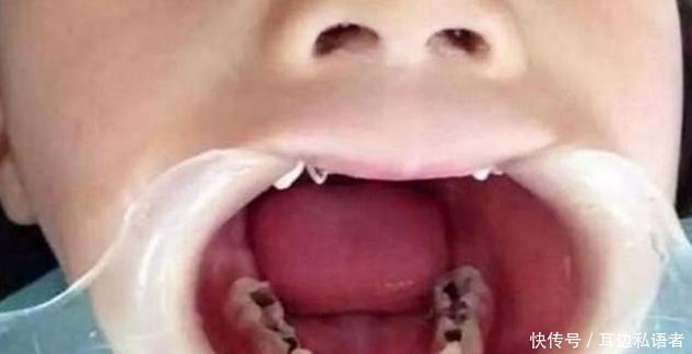 刷牙|3岁儿子满口“小黑牙”,罪魁祸首不是糖果,而是父母的无知