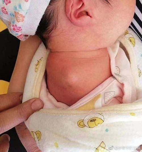 孕妈快看，孕检报告正常出生却没右臂，医院：愿担责30%