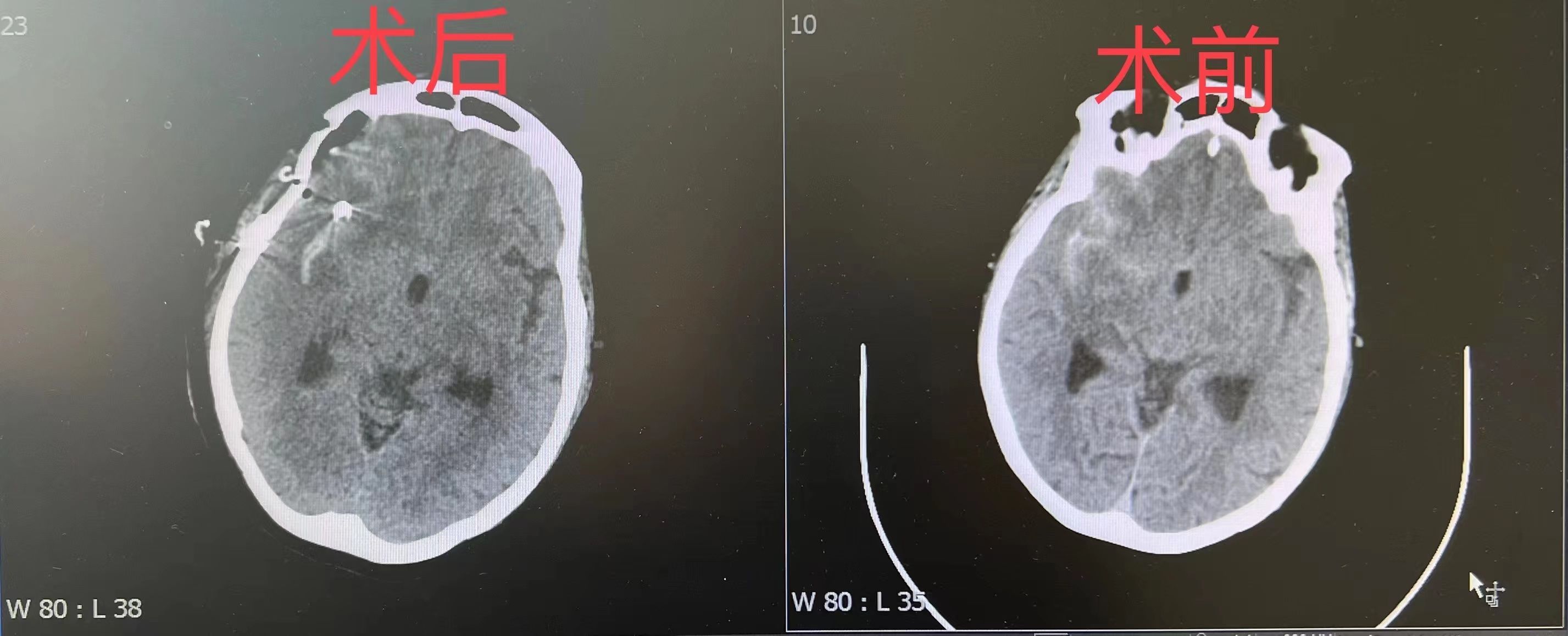 下动脉瘤夹闭术|拆除七旬老人颅内“不定时炸弹”，扬大附院首用内镜辅助成功实施下动脉瘤夹闭术