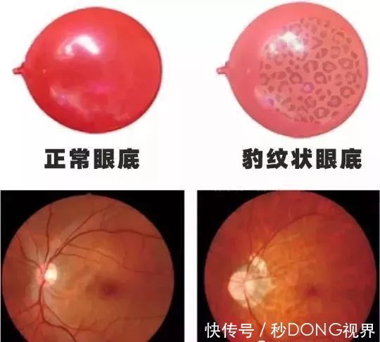 近视|当600变成近视度数,那它将是一个可怕的数字