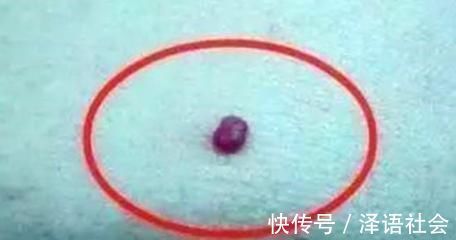 红痣|身上突然长了很多小红痣,是什么原因?其中1个需警惕,不可忽视