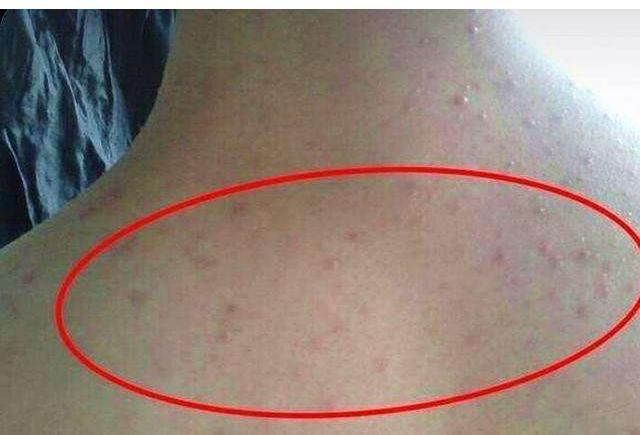 后背上长很多“小米粒”，如何消除？简单三招还你光洁亮丽的后背