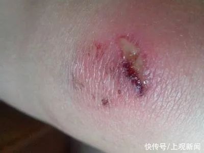 创可贴|小小的创口贴，学问可不少