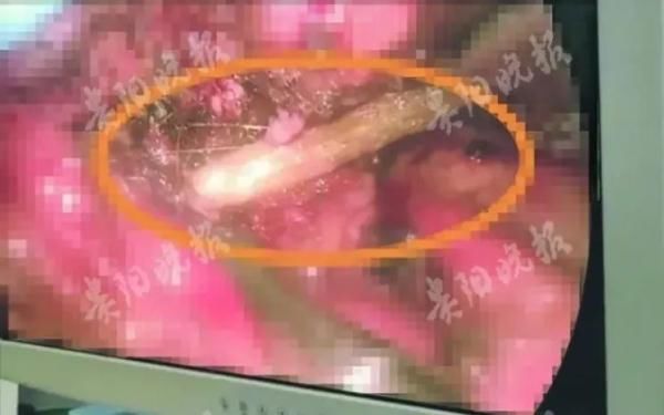 胸腔|真扎心!女子胸痛咳血整5年,竟是9厘米长筷子插在胸腔里…