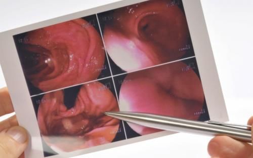 筛查|3个体检指标异常疑似胃癌,出现症状或已是晚期!胃镜该做就做