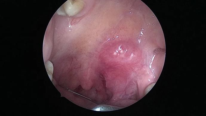 头颈部恶性肿瘤，怎样免除“切骨之痛”？|瑞金医术 | 切除