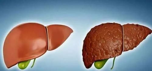 医生|36岁大哥脂肪肝重度,转氨酶从361降到34,医生:3种食物要少吃