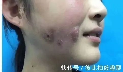 整形 这5个医美项目虽然很火,但很多医生不建议做!丨科普篇