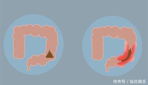 发黑|拉出的屎总是发黑,究竟是什么原因?藏着的问题,怕不简单