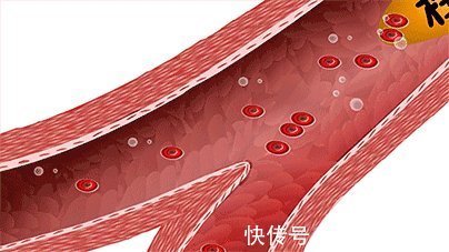 服用阿司匹林|阿司匹林吃吃停停,对发生了动脉硬化和斑块的血管,有哪些影响