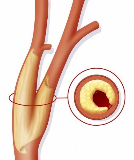 动脉血管|3个人就有1个颈动脉斑块!如何预防和治疗医生说的清清楚楚