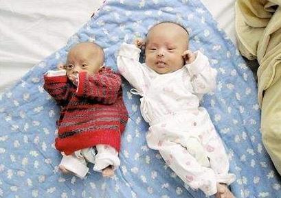 婆婆|双胞胎出生后，一个吃母乳，一个喝奶粉，5个月后差别不是一般大