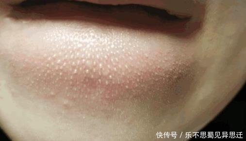 油脂粒 抿紧下巴后突起的“白疙瘩”,千万要注意,这是螨虫的真身吗!
