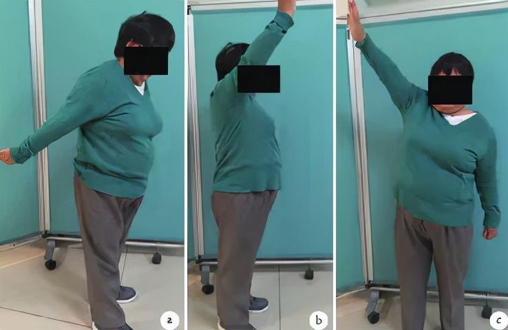 钙化性肌腱炎|长在肩膀上的“结石”:6旬阿姨肩膀半夜痛醒误以为肩周炎,原来是肩袖钙化性肌腱炎