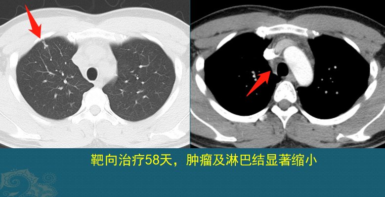 肺鳞癌|肺癌复发和转移的原因是什么？医生用2个病例，指导正确防癌