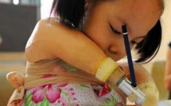 孩子|孕检发现胎儿“没有四肢”,宝妈不顾阻拦坚持生下,如今咋样了