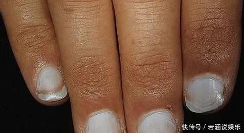 皮肤科|指甲这6个现象，暗示你生病了，要注意，第一个代表患有心脏病