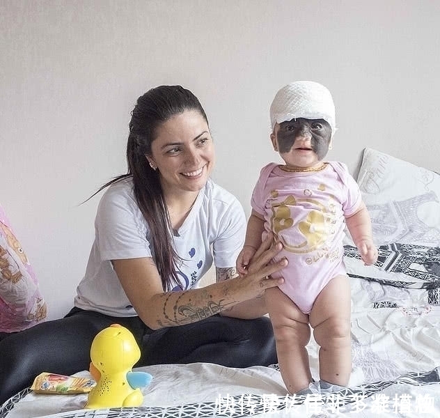 胎记|7个月婴儿脸上因巨大黑色胎记爆红!像带着“蝙蝠侠”面具!