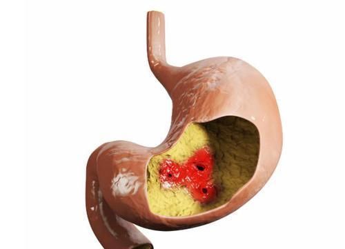 乳腺癌|父母有以下3类癌症,子女就要警惕起来了!最好定期检查