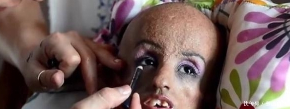 美国一女孩只有15岁,但她的身体却是90岁