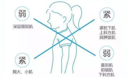 筋膜|颈椎病、富贵包、头痛手麻,都因为这个姿势!如何预防?