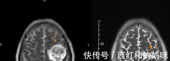 晚期|两位肺癌晚期患者，只因做好了“四件事”，生存期明显延长