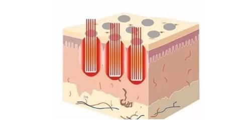 细腻无瑕的肌肤，怎能让毛孔毁了精致