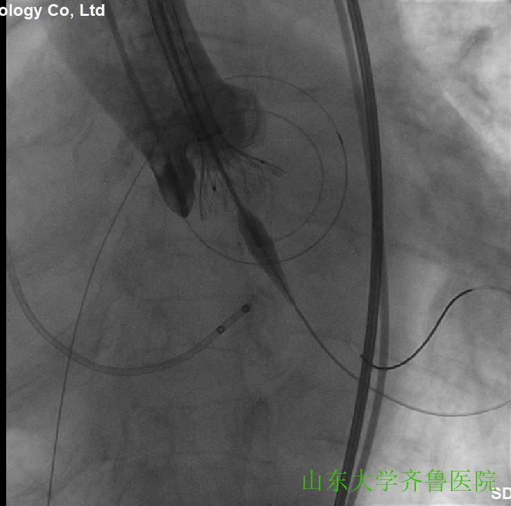患者|省内首例!齐鲁医院完成一站式经导管主动脉瓣置换术(TAVR)+经皮二尖瓣球囊扩张成形术(PBMV)