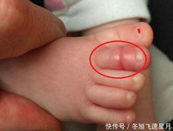 11月龄宝宝脚趾进“虫”，家长紧急送医，医生直言幸好来得早