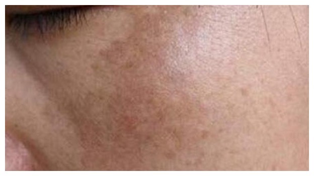 黄褐斑|一块钱的红霉素软膏,怎么成了“淡斑专家”听听医生怎么说