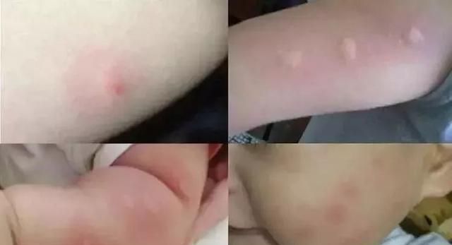 红包|宝宝身上有“红包”，就是被蚊子咬的？这种虫子更要小心