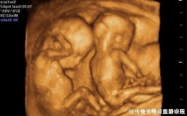 b超|孕期产检不想生个“傻孩子”，这三项产检必须按时做，不能忽视